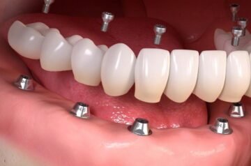 Waarom All-on-4 Tandheelkundige Implantaten de Beste Keuze Zijn voor een Nieuw Gebit