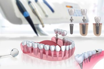 Pourquoi choisir les implants dentaires All-on-5 pour une restauration complète du sourire